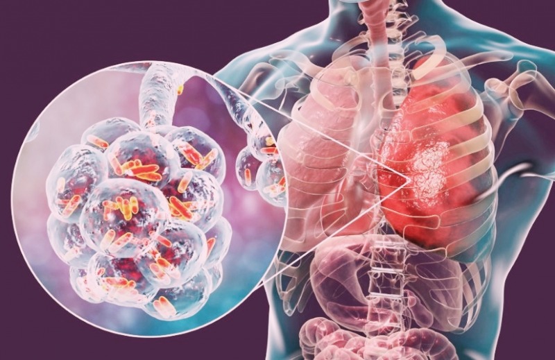Aumentaron un 65% los casos de tuberculosis