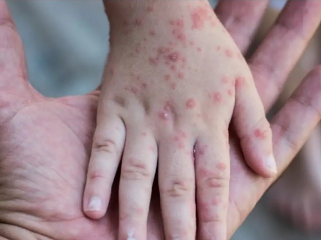 Alerta epidemiolgica por posible brote de sarampin en el pas