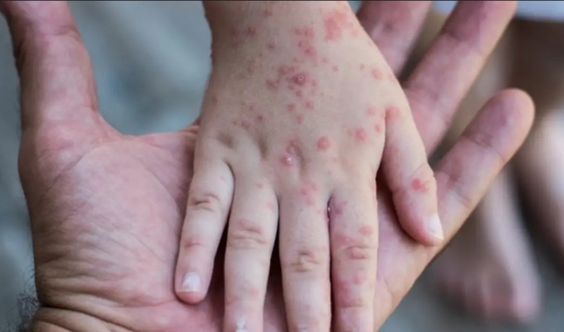 Alerta epidemiolgica por posible brote de sarampin en el pas