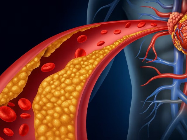 Un tercio de la gente tiene altos niveles de colesterol gentico
